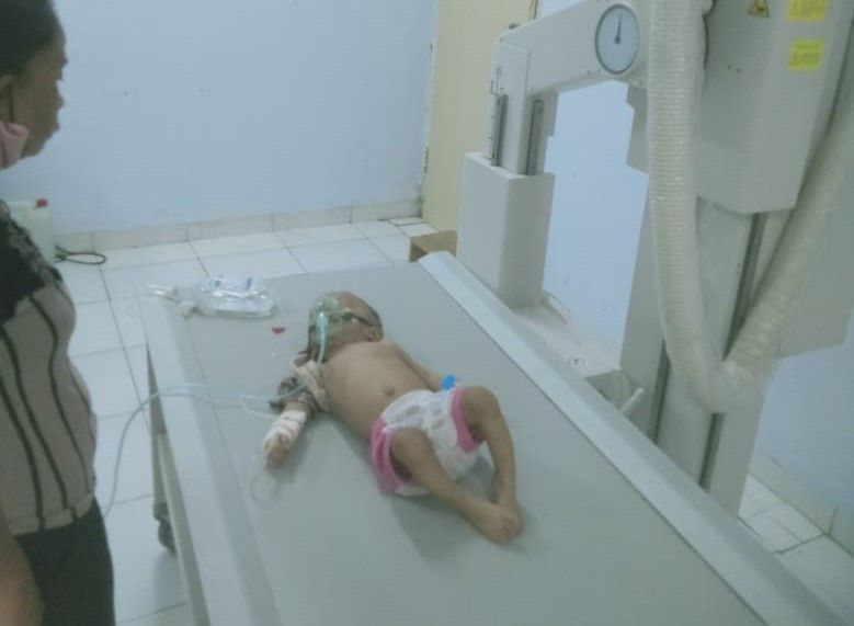 Ayub Alami Sesak Nafas, Bayi Penderita Gizi Buruk yang Tinggal di Kamp Pengungsian Dirawat di RS